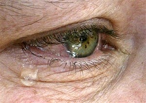 Centro estuda lágrimas para detetar Alzheimer “mais cedo”